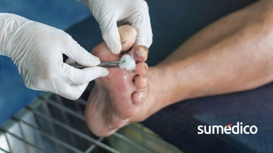 Guía de cuidado del pie diabético: prevención