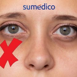 5 trucos que ayudan a eliminar las ojeras de manera natural