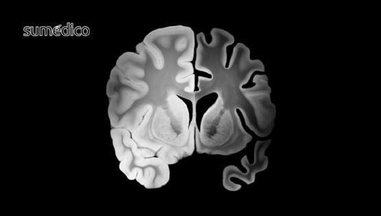 ¿Cómo debo tratar con un familiar con Alzheimer? Consideraciones y cuidados