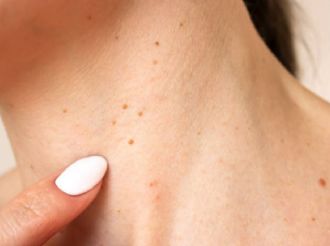 Verrugas: alerta de resistencia a la insulina