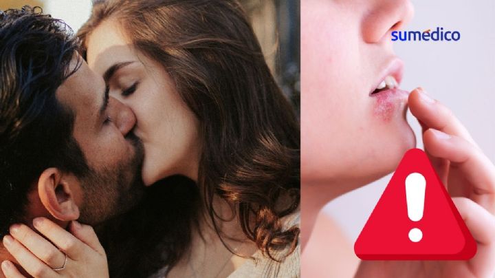 La enfermedad que puedes adquirir a través de los besos y que NO se cura