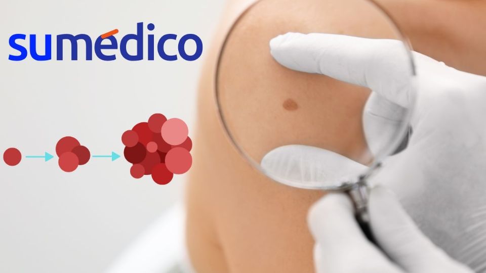 Hay señales sobre el cáncer de piel que NO debes ignorar