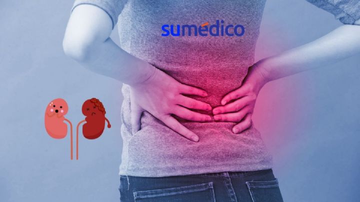 ¿Qué síntomas da el cáncer de riñón? 5 señales que NO debes ignorar