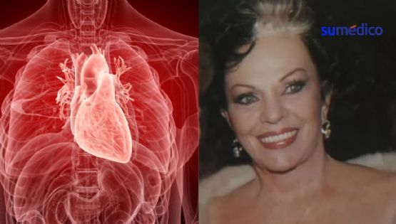 ¿Qué causa un infarto fulminante como el que sufrió Yolanda Montes 'Tongolele'?