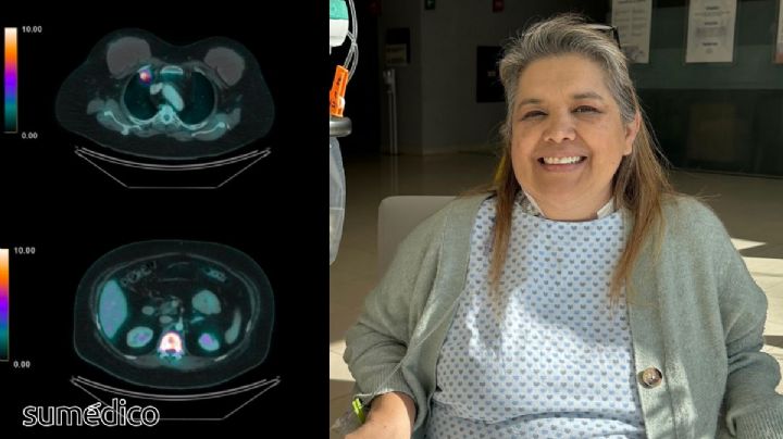 Dijeron que era cáncer de pulmón, pero mi dolor era causado por tuberculosis multiorgánica