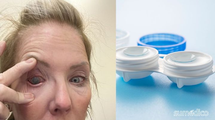 Cometí un error con mis lentes de contacto y ahora enfrento una ceguera