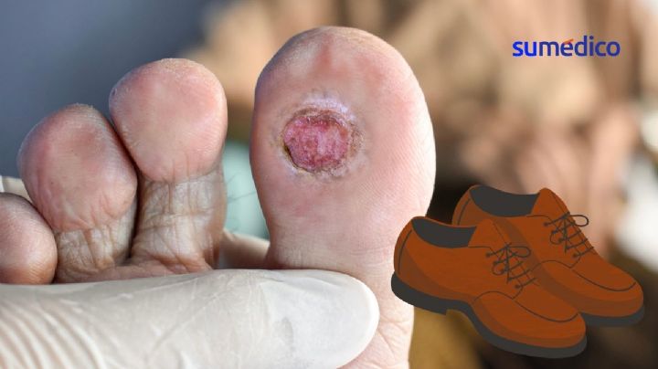 ¿Cómo deben ser mis zapatos si tengo pie diabético?