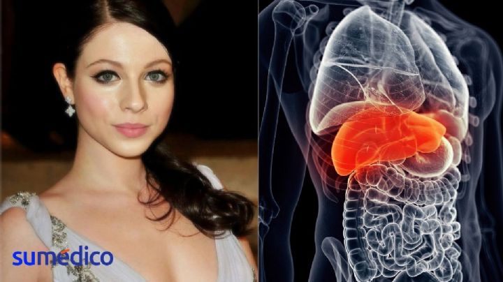 ¿En qué consiste el trasplante de hígado tras el que falleció Michelle Trachtenberg?