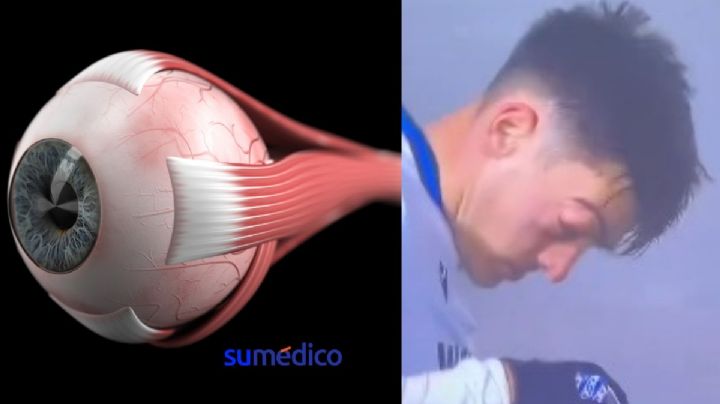 ¿Qué es la exoftalmía por la que a un futbolista se le 'salió' un ojo al sonarse?
