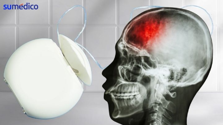 ¿Usar hilo dental puede prevenir un derrame cerebral?