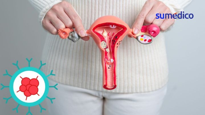 ¿Qué síntomas da el cáncer de útero o matriz? 5 señales que NO debes ignorar