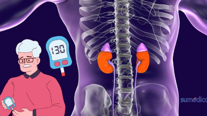 ¿Qué efecto tiene en los riñones la diabetes? 6 síntomas de un daño irreversible