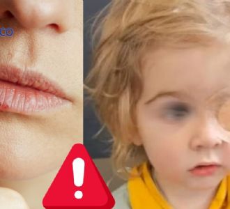 Niño de dos años pierde la vista por beso de una persona con herpes labial
