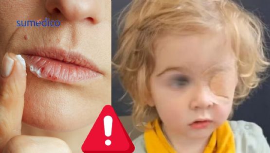Niño de dos años pierde la vista por beso de una persona con herpes labial