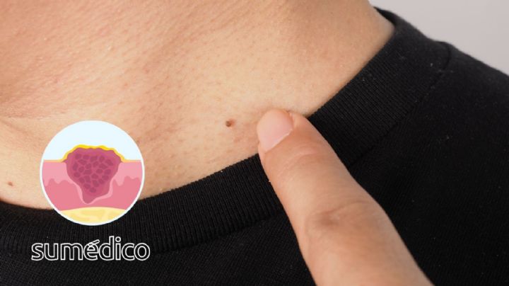 ¿Qué tan peligroso es quitarse una verruga?