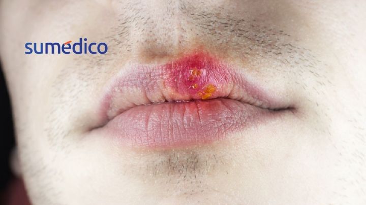 5 razones por las que constantemente te salen fuegos bucales