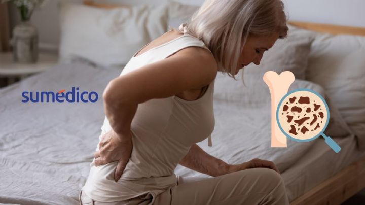 ¿Tienes osteoporosis? Estos son algunos hábitos que debes adoptar