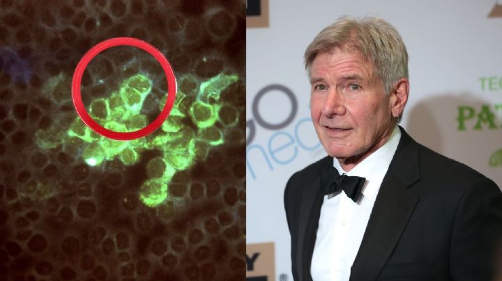 ¿Qué es el herpes zóster por el que Harrison Ford no pudo asistir a los Oscar?