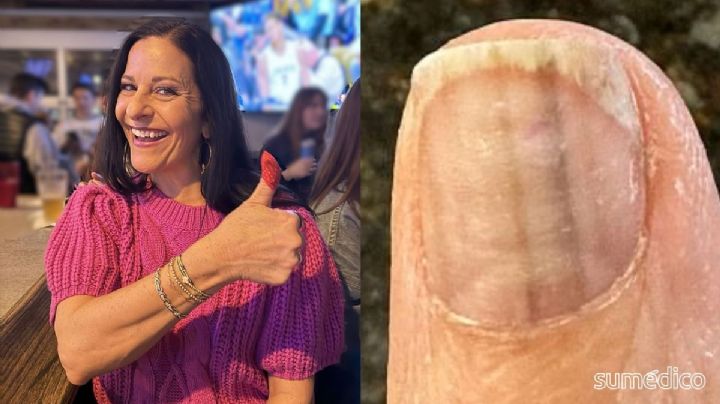 ‘Descubrí que tenía melanoma después de un manicure y eso me salvó la vida’