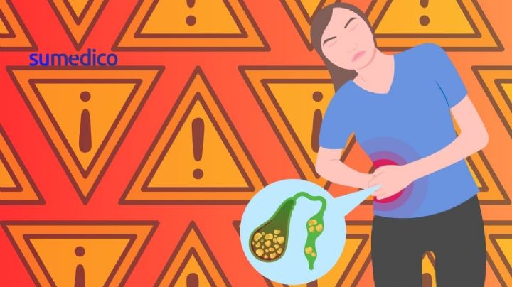 ¿Qué síntomas dan los cálculos biliares? 5 señales que NO debes ignorar