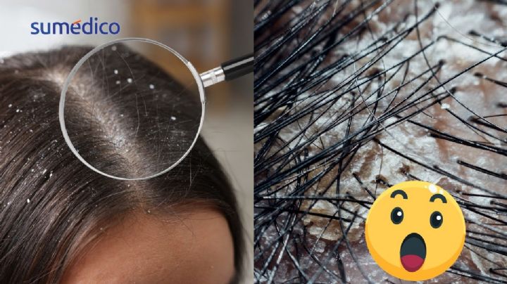 Dermatóloga comparte el truco para eliminar la caspa definitivamente
