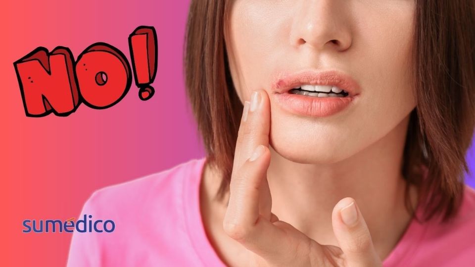 El fuego labial no se cura, solo se controla con un tratamiento.