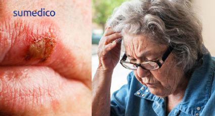 ¿Sufres de fuegos labiales? Podrías tener más riesgo de esta enfermedad