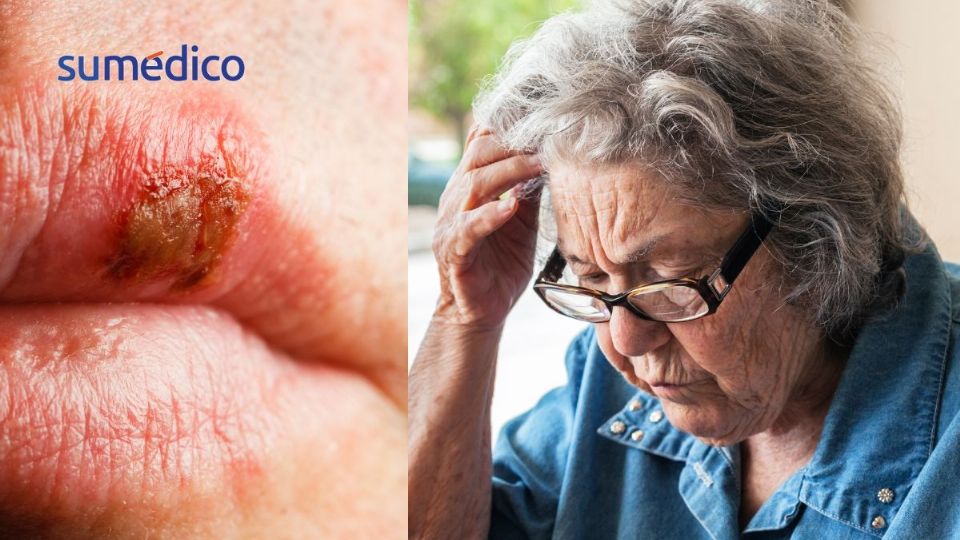 El herpes labial puede causar más que lesiones en la boca.
