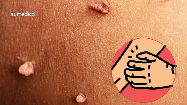 ¿Tus verrugas sangran? Principales causas y lo que hay que hacer