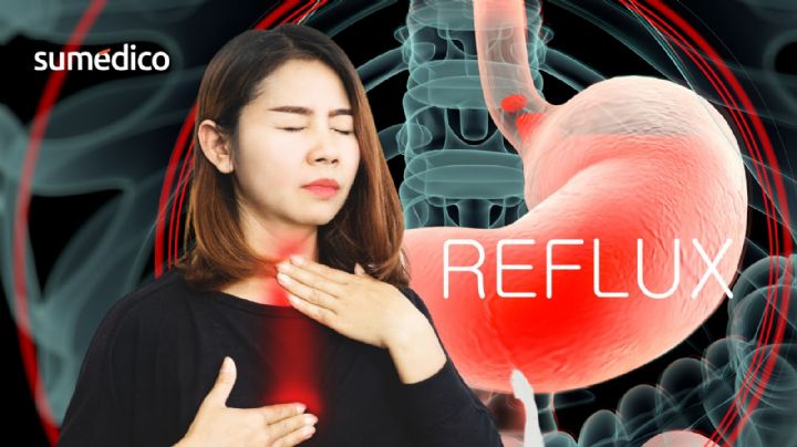 ¿Tienes reflujo? Cuidado, podría ser esta enfermedad