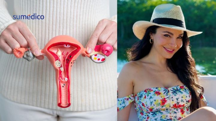 ¿Qué son los miomas que le quitaron a Martha Higareda para poder embarazarse?