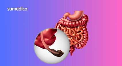¿Qué síntomas da el cáncer de apéndice y por qué es más común en millenials?