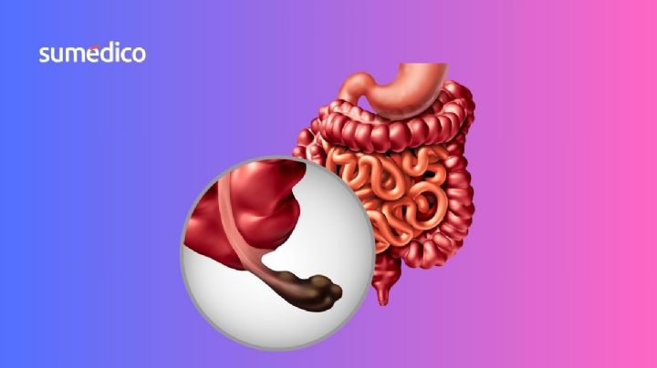 ¿Qué síntomas da el cáncer de apéndice y por qué es más común en millenials?