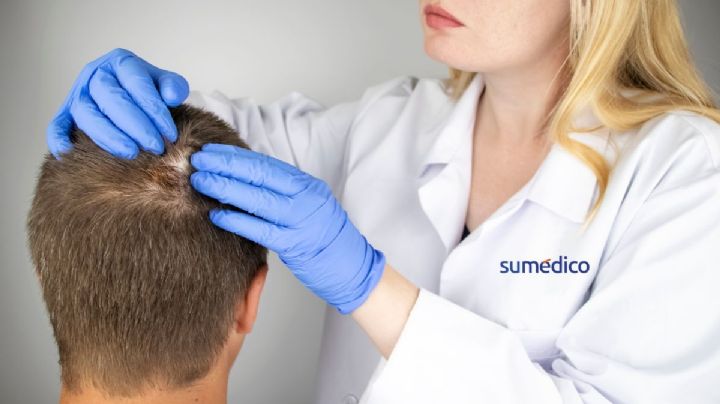 ¿Adiós a la alopecia? Un experimento consiguió resultados prometedores