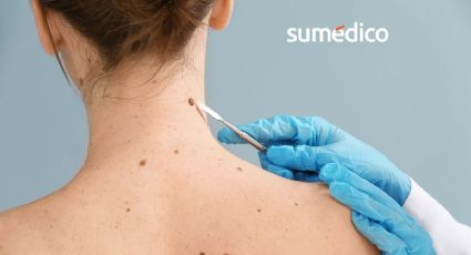 5 señales que indican que hay que acudir al dermatólogo