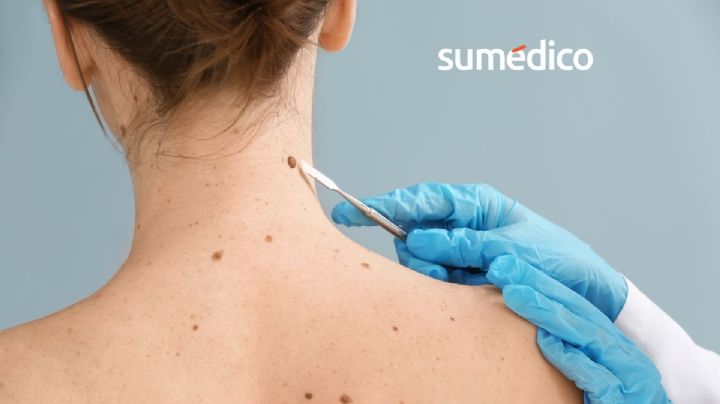 5 señales que indican que hay que acudir al dermatólogo