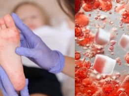 Diabetes: ¿Es normal sentir excesiva picazón en los pies?
