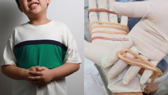 Así encontraron más de 140 parásitos intestinales en un niño de Chiapas