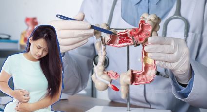 Divertículos en el colon: síntomas que NO debes ignorar