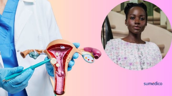“Me extirparon 30 miomas uterinos”: Lupita Nyong’o habla sobre su condición