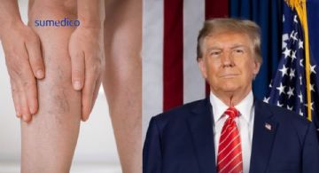 Qué es la insuficiencia venosa crónica que padece Donald Trump y cómo afecta