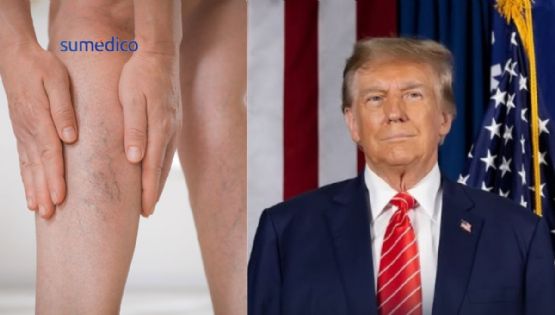 Qué es la insuficiencia venosa crónica que padece Donald Trump y cómo afecta