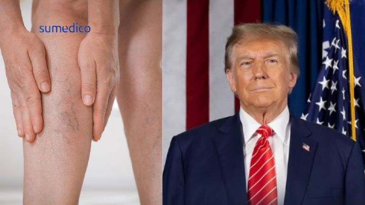 Qué es la insuficiencia venosa crónica que padece Donald Trump y cómo afecta