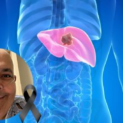¿Qué causa el cáncer de hígado y pulmón que sufrió el comediante Carlos Merced?