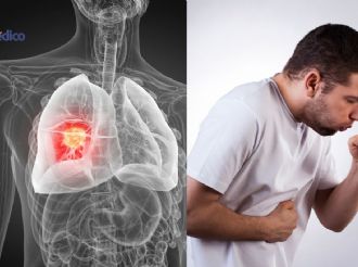 5 señales del cáncer de pulmón que NO debes ignorar