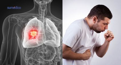 Cáncer de pulmón sin fumar: Estudio revela el factor invisible que lo causaría