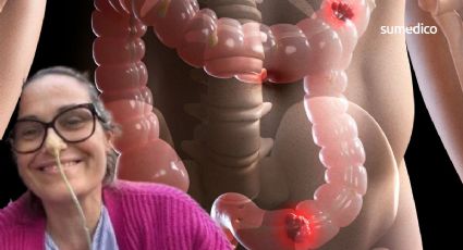‘Creí que eran síntomas de perimenopausia, pero tenía cáncer de intestino’
