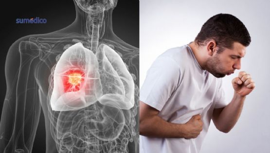 Cáncer de pulmón sin fumar: Estudio revela el factor invisible que lo causaría
