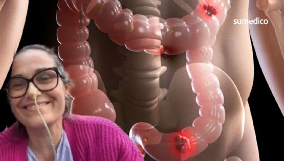 ‘Creí que eran síntomas de perimenopausia, pero tenía cáncer de intestino’