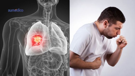 5 señales del cáncer de pulmón que NO debes ignorar